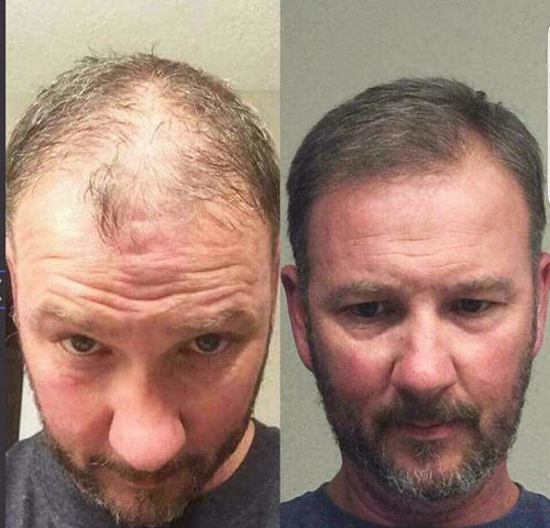 Minoxidil Kirkland Espuma